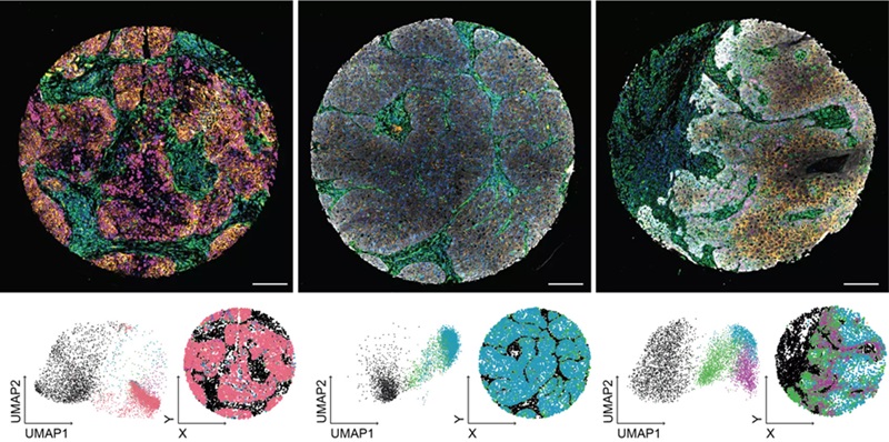 Image: The new technique allows properties of cancer cells and their surrounding tissue to be analyzed in detail at single-cell level (Photo courtesy of Universität Helsinki/Karolina Punovuori)